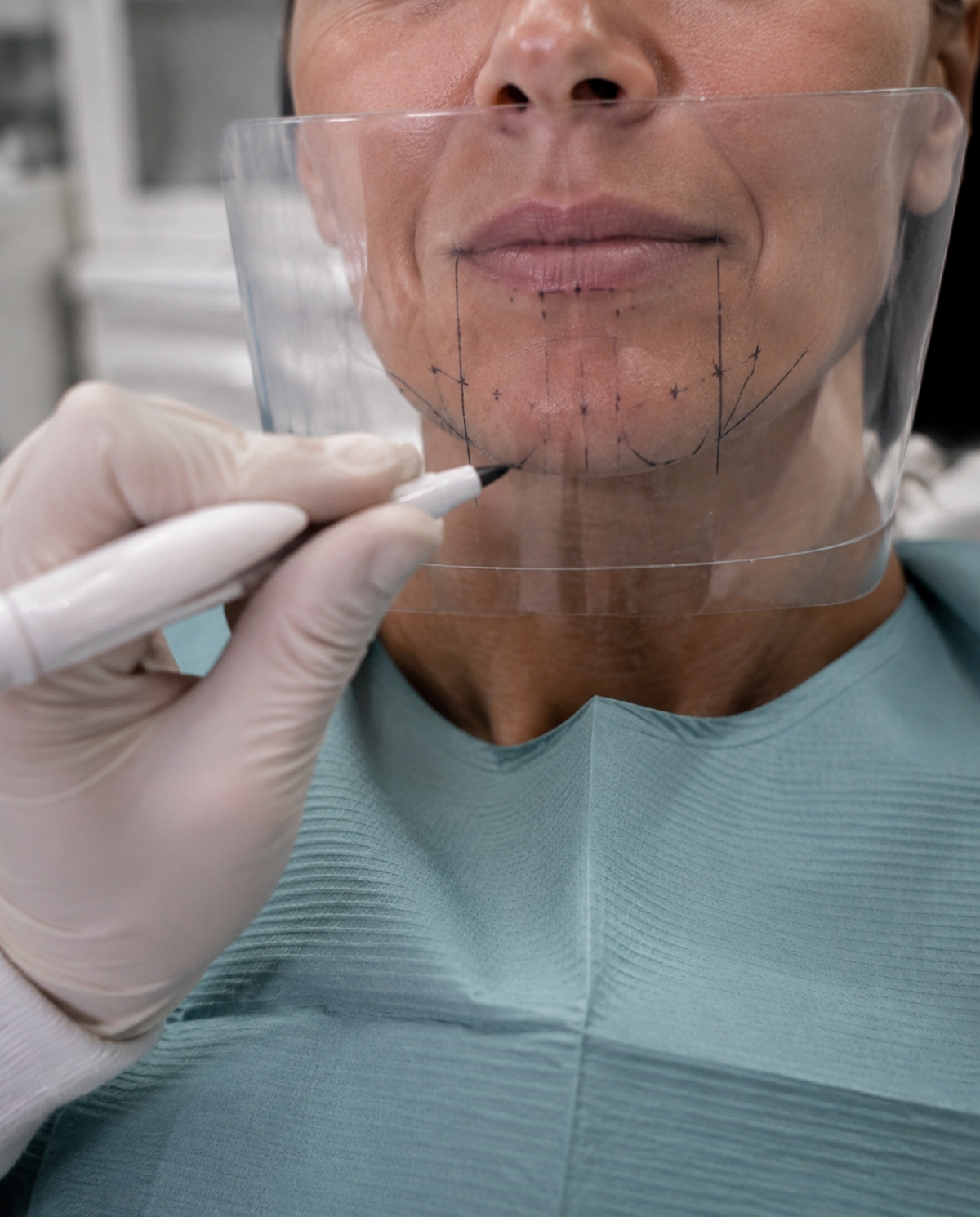 Dentist marking reference points on a transparent shield positioned in front of a patient’s lips, chin, smile lines, and jaw.